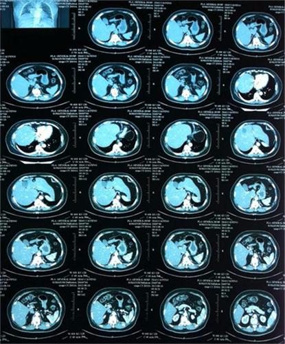 醫(yī)用CT膠片-激光藍(lán)基膠片
