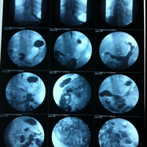 醫(yī)用放射膠片-噴墨藍(lán)基膠片